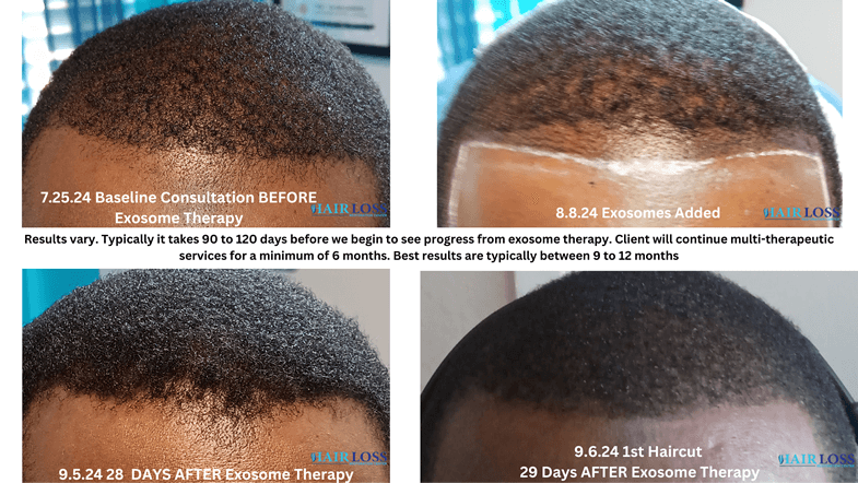 HLRC Male Exosome Therapy Front Hair Line 7.25 to 9.6.24