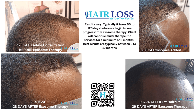 HLRC Male Exosome Therapy Right Front Hair Line 7.25 to 9.6.24